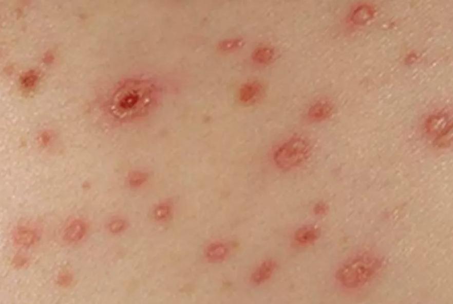 艾滋病皮肤表现_艾滋病早期症状_艾滋病与水痘