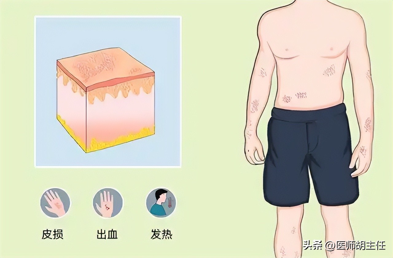 艾滋病早期症状_艾滋病皮肤病变_艾滋病与水痘