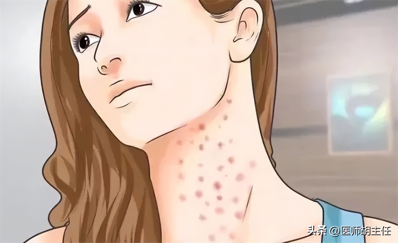 艾滋病早期症状_艾滋病与水痘_艾滋病皮肤病变