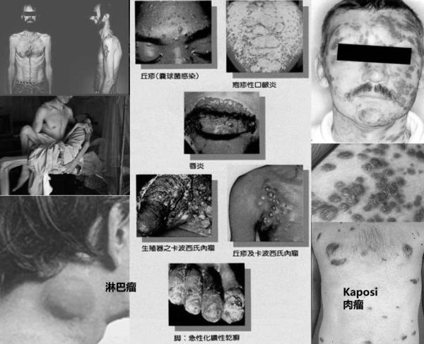 艾滋病与水痘_艾滋病机会性感染症状_艾滋病病毒感染机制