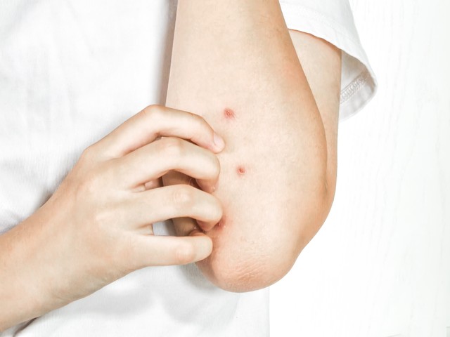 HIV感染早期皮肤症状_艾滋病女性手臂皮肤异常_艾滋病与水痘