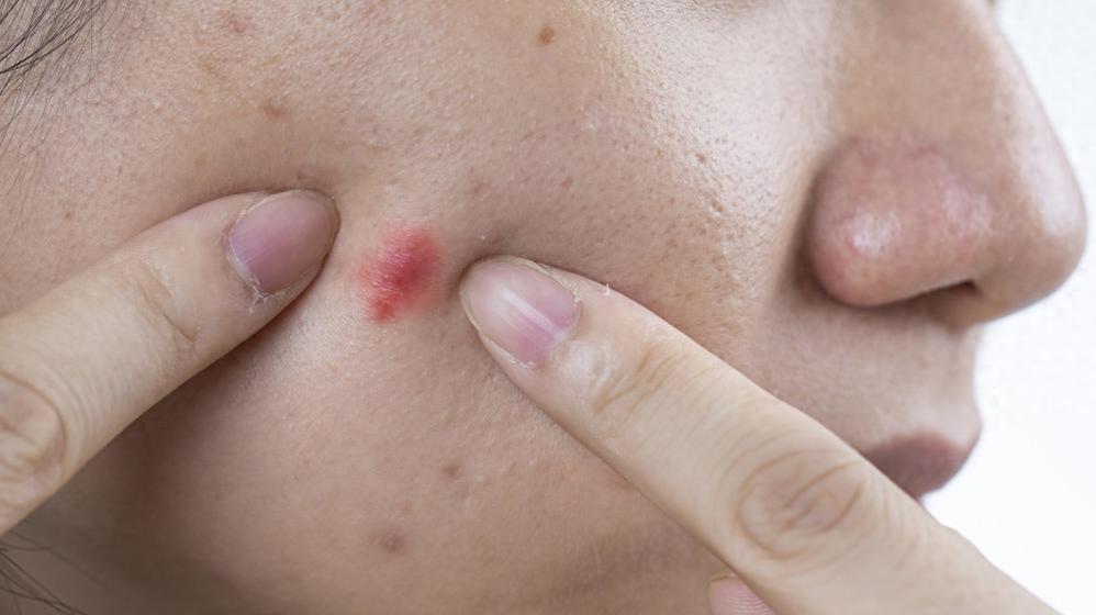 kiayun手机版登录app游戏登录入口.手机端安装.cc 科普｜如何战胜“青春痘”？