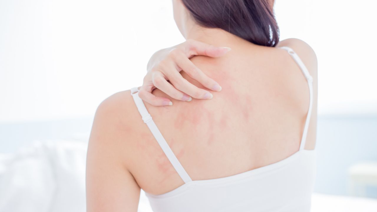 艾滋病皮肤症状_艾滋病与水痘_带状疱疹与艾滋病