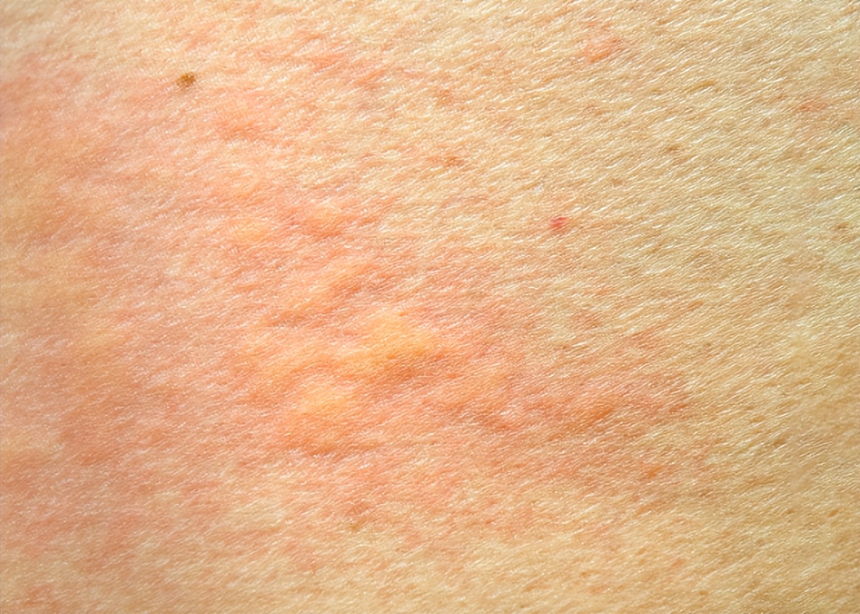 艾滋病皮肤症状_艾滋病与水痘_带状疱疹与艾滋病