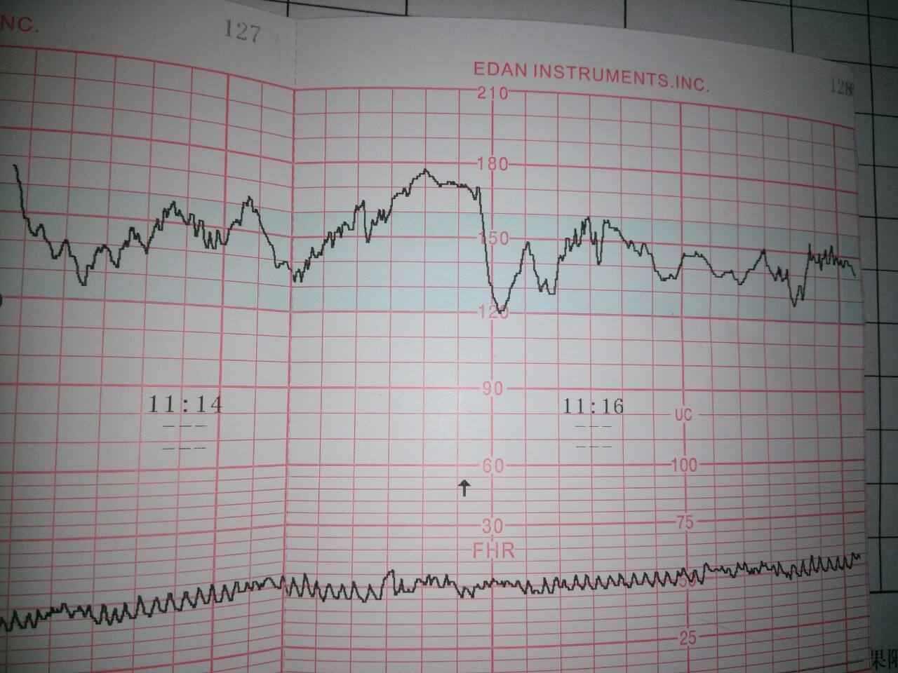 胎心监护在家医院区别_听诊式胎心监护超声多普勒区别_听诊器原理生活应用