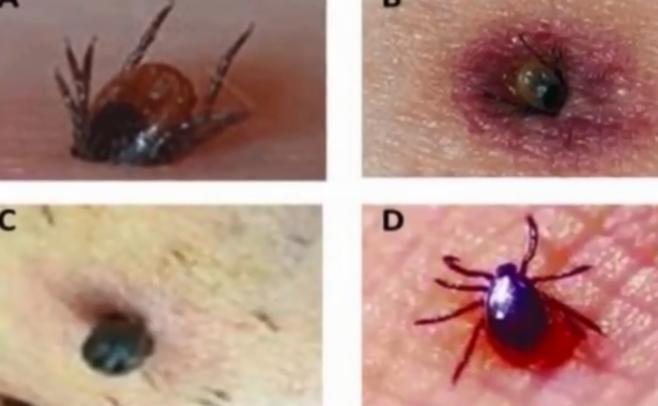 蜱虫叮咬 新型布尼亚病毒 马鞍山蜱虫叮咬_脾虫咬后的伤口图